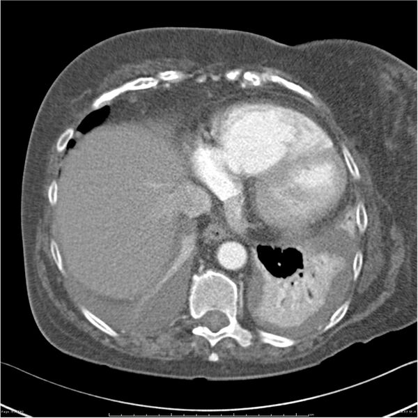 File:Acute-on-chronic pulmonary emboli (Radiopaedia 27925-28169 C+ CTPA 63).jpg