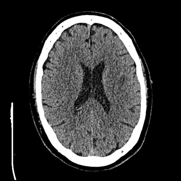 File:Acute A3 occlusion with ACA ischemic penumbra (CT perfusion) (Radiopaedia 72036-82525 Axial non-contrast thins 58).jpg