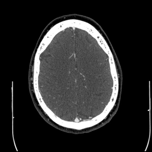 File:Acute A3 occlusion with ACA ischemic penumbra (CT perfusion) (Radiopaedia 72036-82527 Axial C+ arterial phase thins 5).jpg