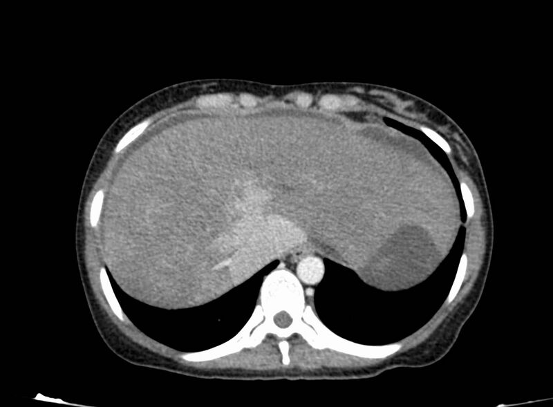 File:Acute Budd-Chiari syndrome (Radiopaedia 60858-68638 Axial C+ portal venous phase 38).jpg