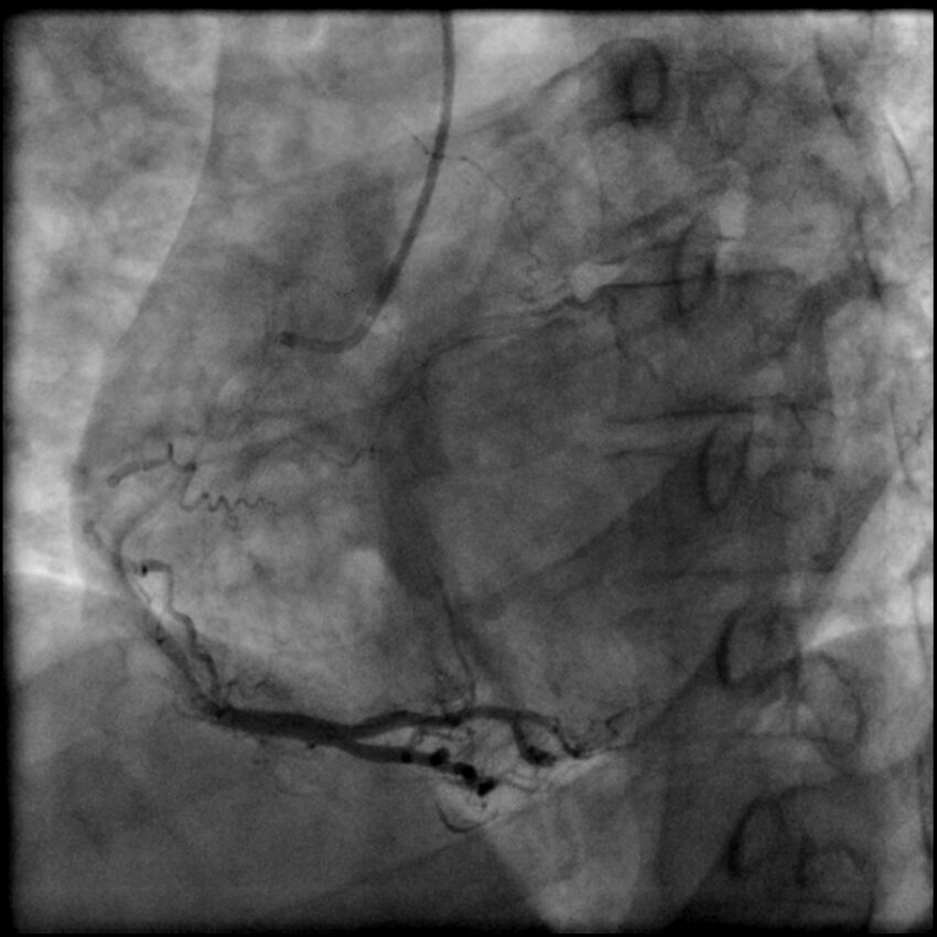 Acute anteroseptal myocardial infarction (Radiopaedia 68409-77946 RAO straight RCA 53).jpg