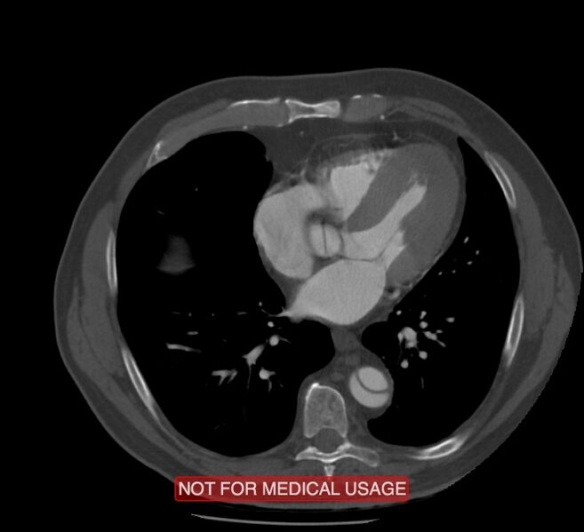 File:Acute aortic dissection - Stanford type A (Radiopaedia 40661-43285 Axial C+ arterial phase 45).jpg