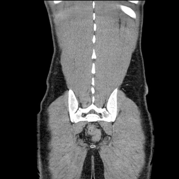 File:Acute appendicitis (Radiopaedia 27049-27227 Coronal C+ portal venous phase 52).jpg