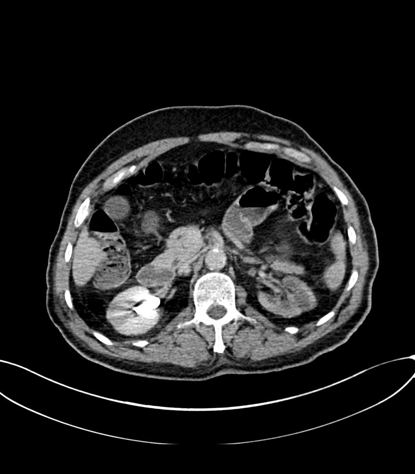 Acute arterial mesenteric ischemia (Radiopaedia 78238-90828 Axial C+ delayed 51).jpg