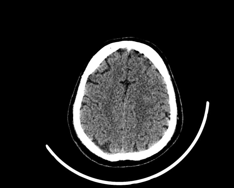 File:Acute cerebral infarct (Radiopaedia 35604-37123 Axial non-contrast 79).jpg