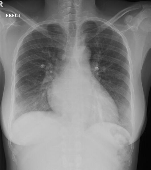 File:Acute chest syndrome - sickle cell disease (Radiopaedia 42375-45498 Frontal 1).jpg