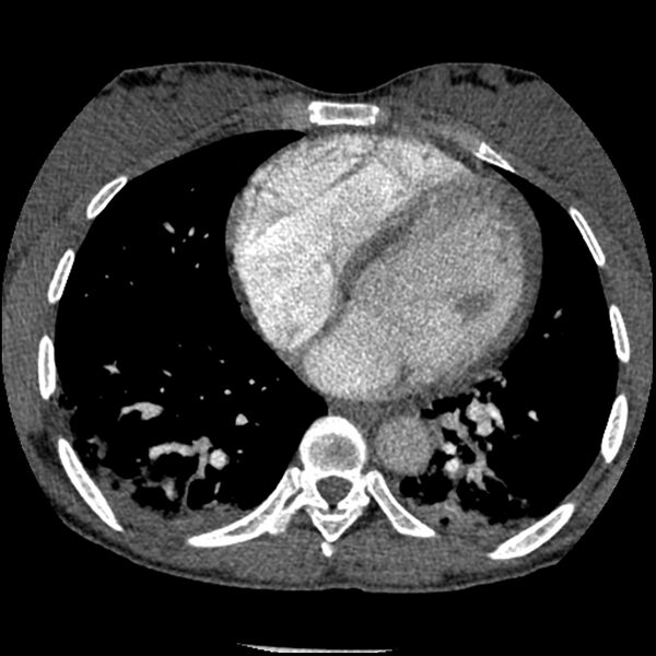 File:Acute chest syndrome - sickle cell disease (Radiopaedia 42375-45499 Axial C+ CTPA 122).jpg