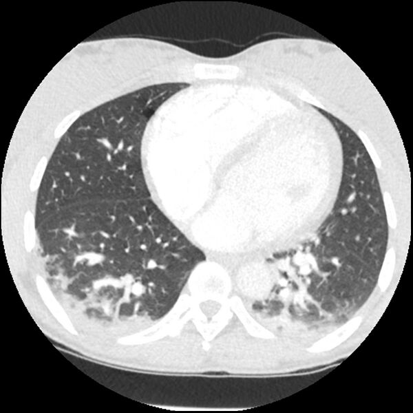 File:Acute chest syndrome - sickle cell disease (Radiopaedia 42375-45499 Axial lung window 124).jpg
