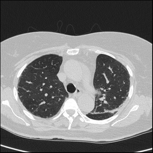 File:Acute interstitial pneumonitis (Radiopaedia 45404-49453 Axial lung window 29).jpg