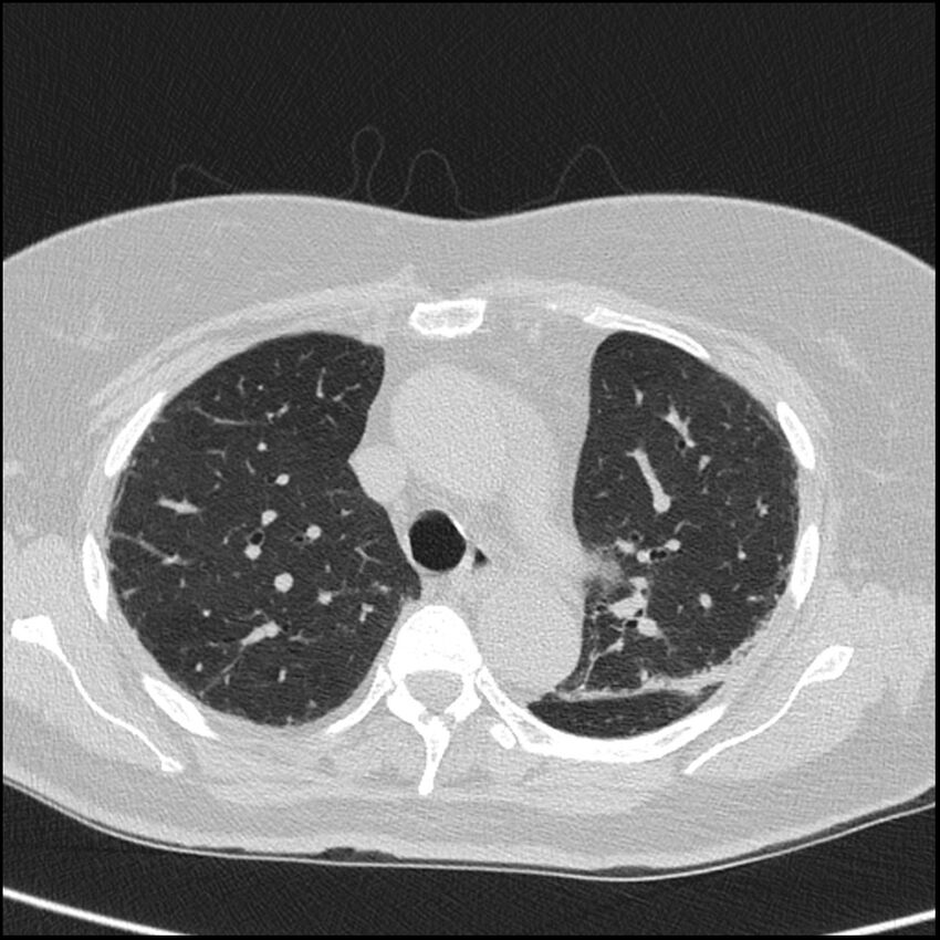 Acute interstitial pneumonitis (Radiopaedia 45404-49453 Axial lung window 29).jpg