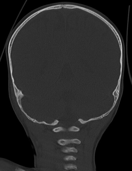File:Acute mastoiditis (Radiopaedia 82678-96881 Coronal bone window 56).jpg