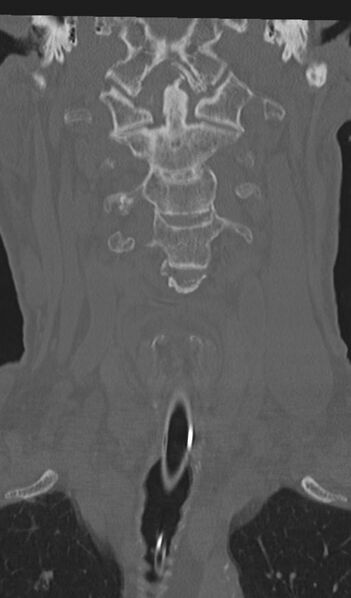 File:Acute on chronic subdural hematoma and thoracic vertebral injury in a multitrauma patient (Radiopaedia 31698-32619 Coronal bone window 16).jpg