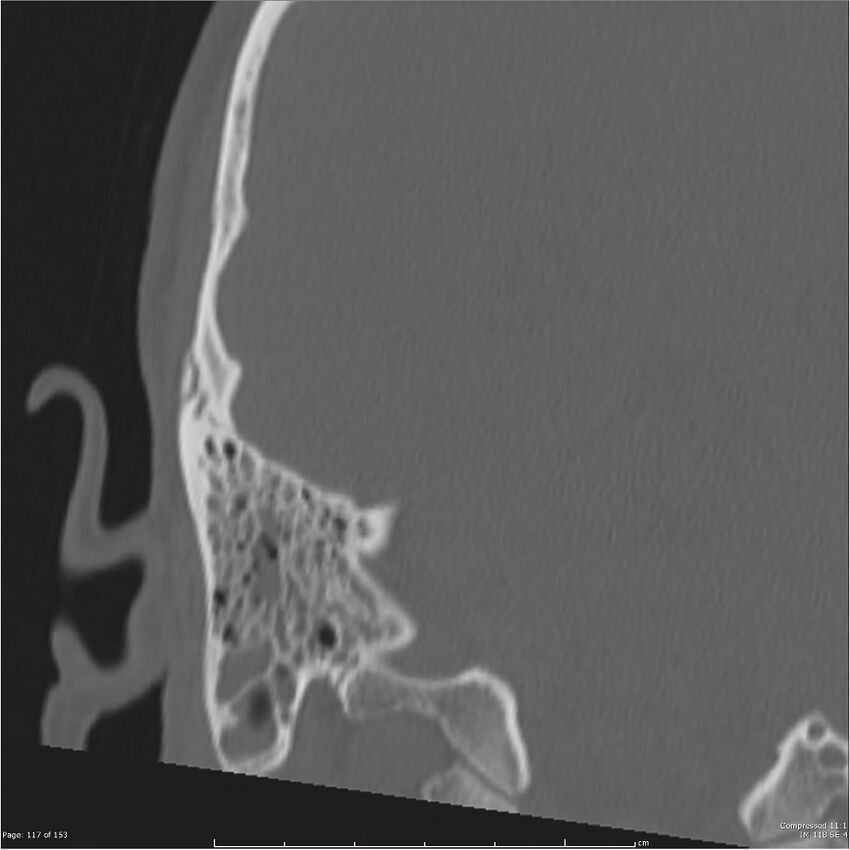 Acute otomastoiditis (Radiopaedia 28276-28512 Coronal PTB bone window reformat 48).jpg