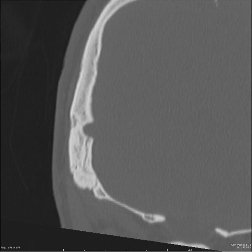 Acute otomastoiditis (Radiopaedia 28276-28512 Coronal PTB bone window reformat 82).jpg