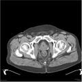 Acute pancreatitis (Radiopaedia 19135-19116 Axial non-contrast 57).jpg