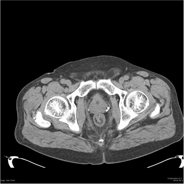 File:Acute pancreatitis (Radiopaedia 19135-19116 Axial non-contrast 57).jpg