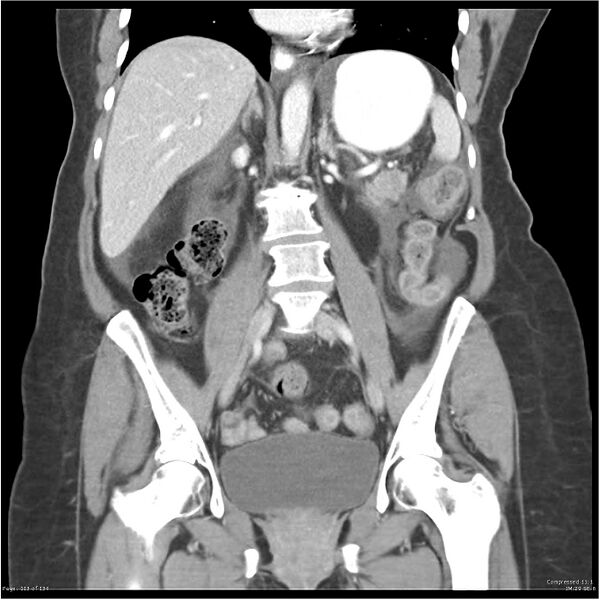 File:Acute pancreatitis (Radiopaedia 19136-19117 Coronal C+ portal venous phase 23).jpg