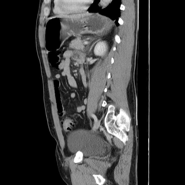 File:Acute pancreatitis (Radiopaedia 22572-22596 Sagittal C+ portal venous phase 35).jpg