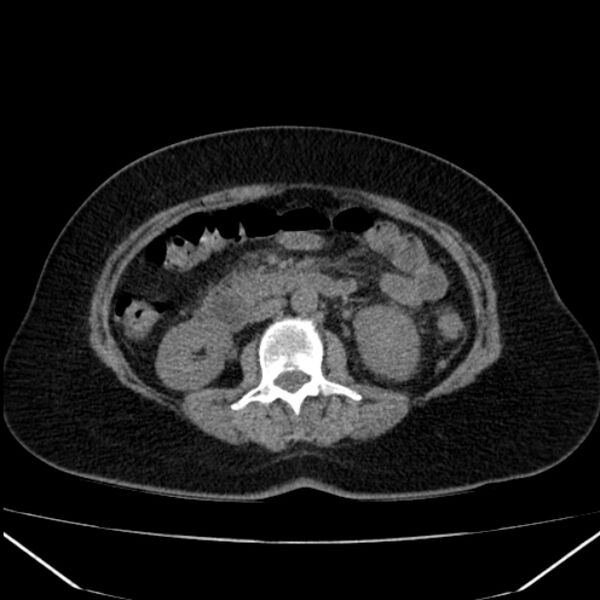 File:Acute pancreatitis - Balthazar C (Radiopaedia 26569-26714 Axial non-contrast 45).jpg