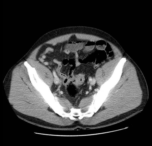 File:Acute pancreatitis - Balthazar E (Radiopaedia 23080-23110 Axial C+ portal venous phase 60).jpg