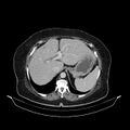 Acute pyelonephritis (Radiopaedia 25657-25837 Axial renal parenchymal phase 18).jpg