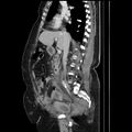 Acute pyelonephritis (Radiopaedia 25657-25837 Sagittal renal parenchymal phase 37).jpg