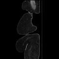 Acute pyelonephritis (Radiopaedia 25657-25837 Sagittal renal parenchymal phase 8).jpg