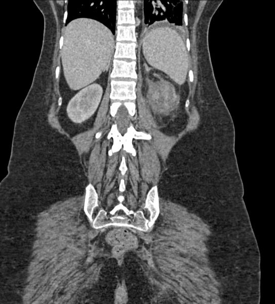 File:Acute pyelonephritis with renal vein thrombosis (Radiopaedia 58020-65053 Coronal renal parenchymal phase 100).jpg