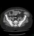 Acute renal failure post IV contrast injection- CT findings (Radiopaedia 47815-52557 Axial non-contrast 62).jpg
