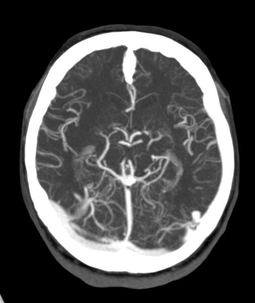 File:Acute right MCA M1 occlusion (Radiopaedia 62268-70454 Axial Phase 2 16).jpg