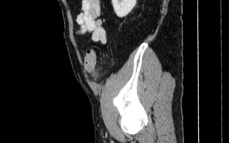 File:Acute sigmoid colon diverticulitis (Radiopaedia 55507-61976 Sagittal C+ portal venous phase 107).jpg
