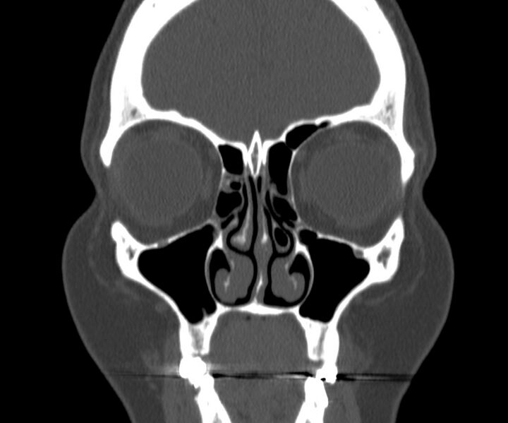 File:Acute sinusitis (Radiopaedia 22419-22455 Coronal bone window 12).jpg
