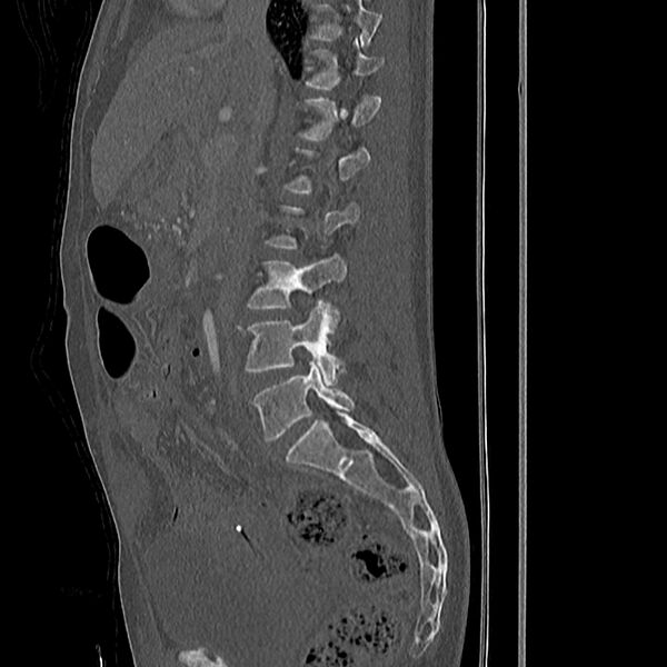 File:Acute vertebral body compression fractures (Radiopaedia 31757-32693 Sagittal bone window 34).jpg