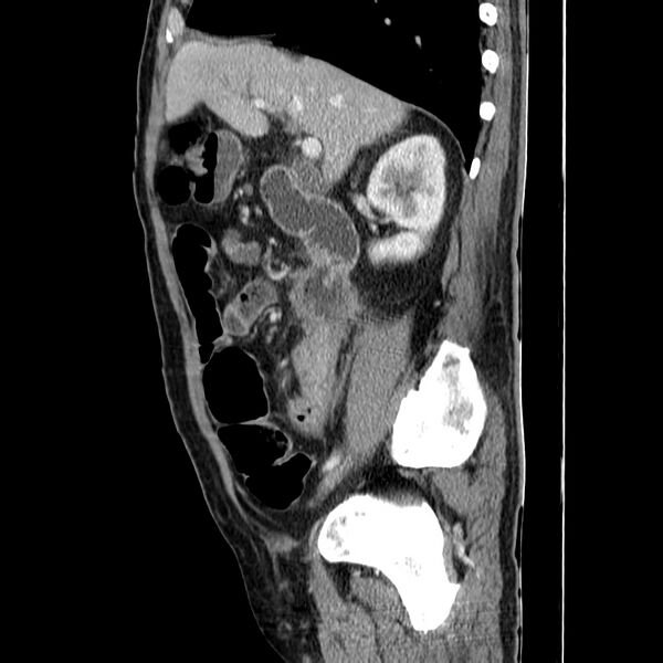 File:Adenocarcinoma of colon with entero-colic fistula (Radiopaedia 22832-22852 Sagittal C+ portal venous phase 23).jpg