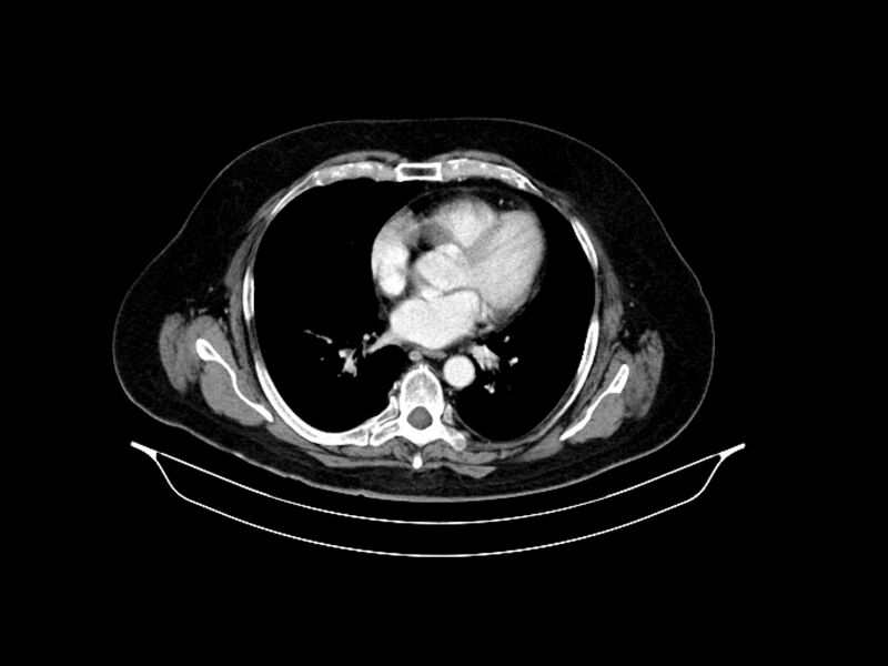 File:Adenocarcinoma of pancreas with hepatic metastasis (Radiopaedia 64332-73122 Axial C+ portal venous phase 7).jpg