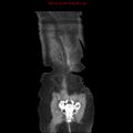 Adenocarcinoma of the colon (Radiopaedia 8191-9039 Coronal liver window 45).jpg