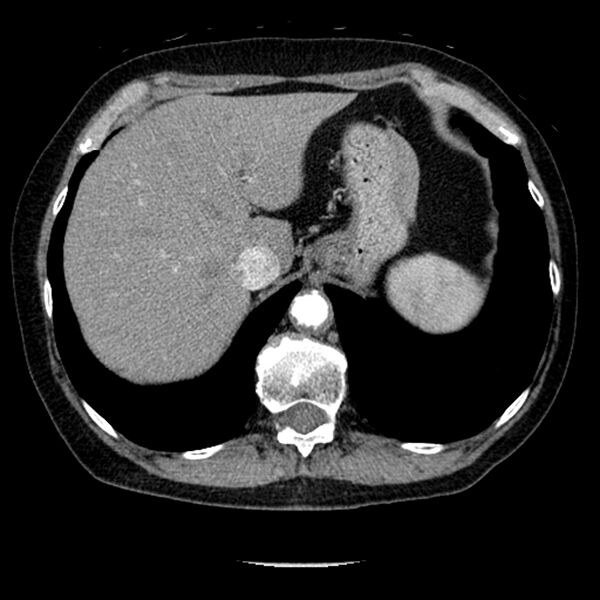 File:Adenocarcinoma of the lung (Radiopaedia 41015-43755 Axial C+ portal venous phase 109).jpg
