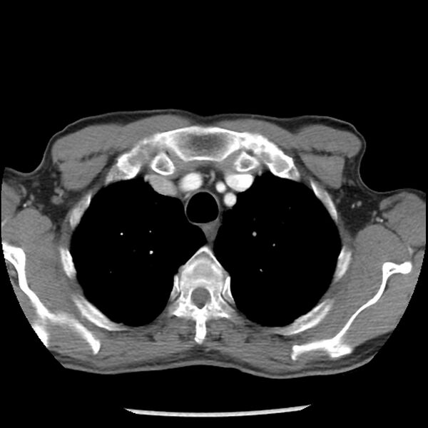 File:Adenocarcinoma of the lung - micropapillary predominant (Radiopaedia 42446-45563 Axial C+ portal venous phase 13).jpg