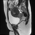 Adenomyosis - ovarian endometriomas (Radiopaedia 67031-76350 Sagittal T2 8).jpg