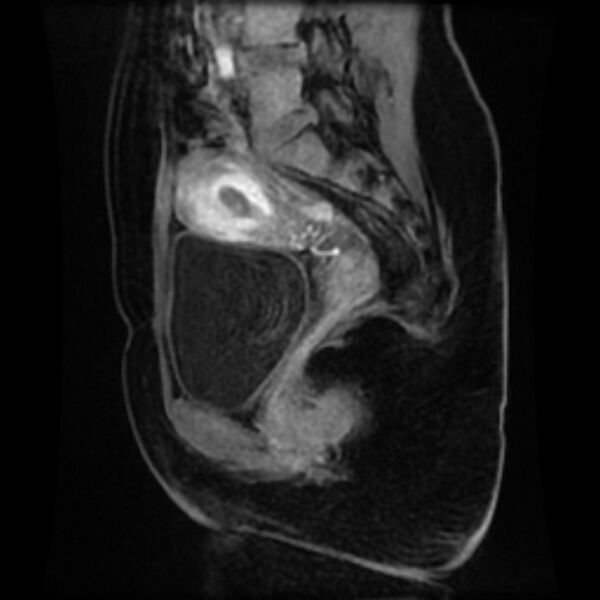 File:Adenomyosis within a septate uterus (Radiopaedia 69963-79981 Sagittal LAVA-Dyn 13).jpg