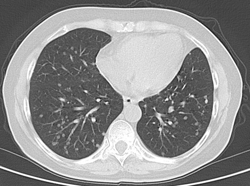 File:Adenosquamous lung carcinoma (Radiopaedia 22035-22030 lung window 41).jpg
