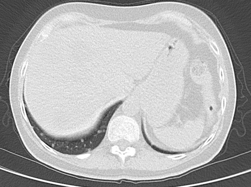 File:Adenosquamous lung carcinoma (Radiopaedia 22035-22030 lung window 54).jpg
