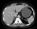 Adrenal myelolipoma (Radiopaedia 65761).png