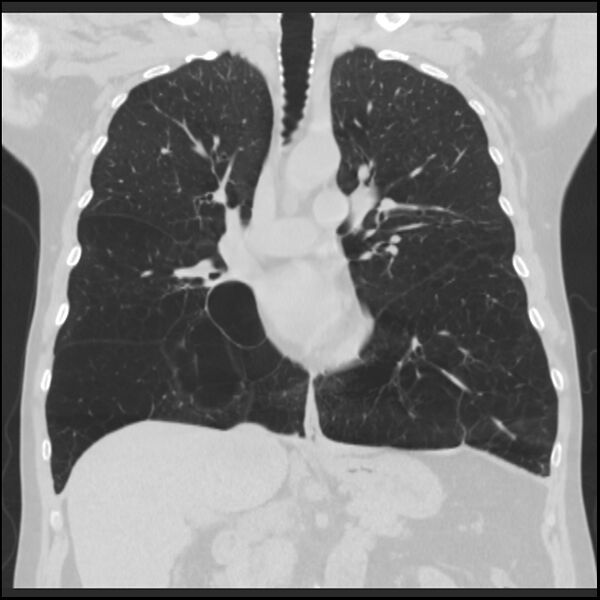 File:Alpha-1-antitrypsin deficiency (Radiopaedia 40993-43722 Coronal lung window 47).jpg