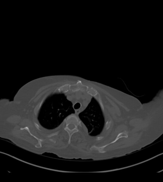 File:Amiodarone deposition in the liver (Radiopaedia 77587-89780 Axial bone window 16).jpg