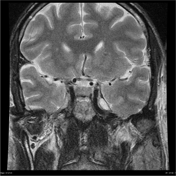 File:Amnestic syndrome secondary to hypoxic brain injury (Radiopaedia 24743-25004 F 14).jpg