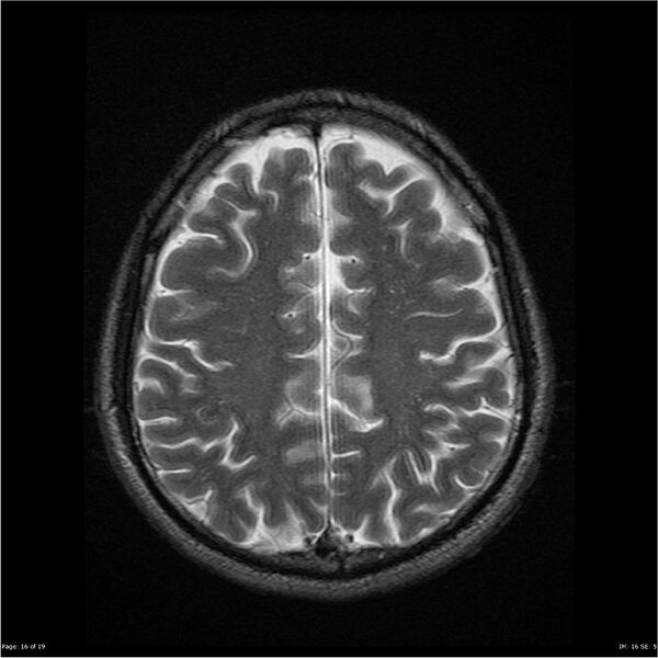 File:Amnestic syndrome secondary to hypoxic brain injury (Radiopaedia 24743-25004 T2 16).jpg