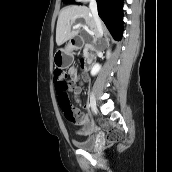 File:Ampullary tumor (Radiopaedia 22787-22816 D 24).jpg