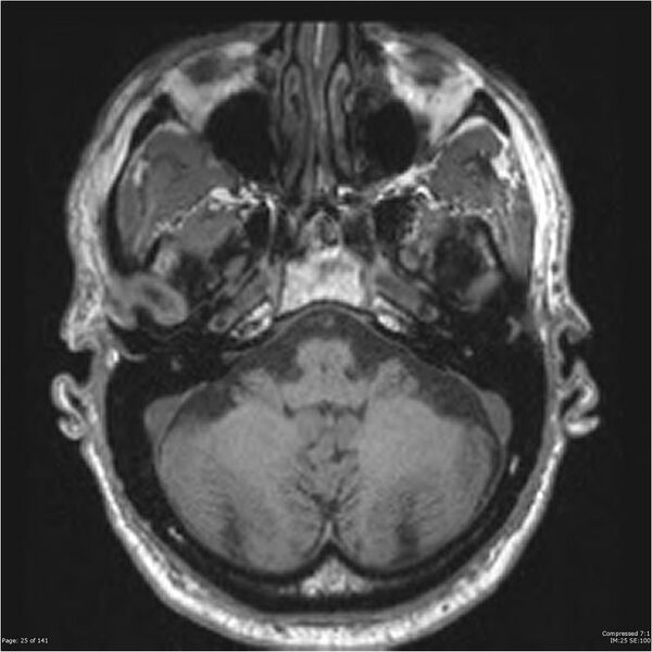 File:Anaplastic meningioma with recurrence (Radiopaedia 34452-35788 Axial T1 23).jpg
