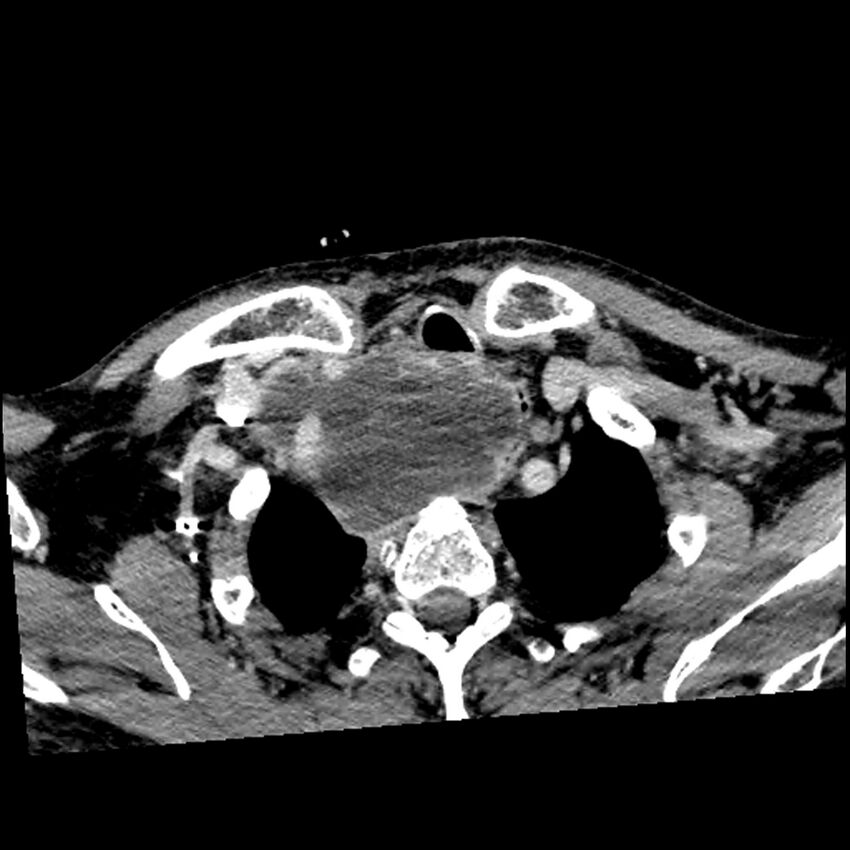 Anaplastic thyroid carcinoma (Radiopaedia 79087-92034 B 29).jpg